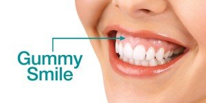 gummy smile treatment sherman oaks